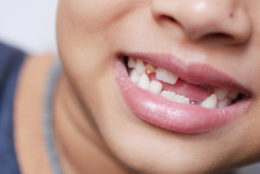 Close up of an african american with missing teeth to describe oral health issues in kids.