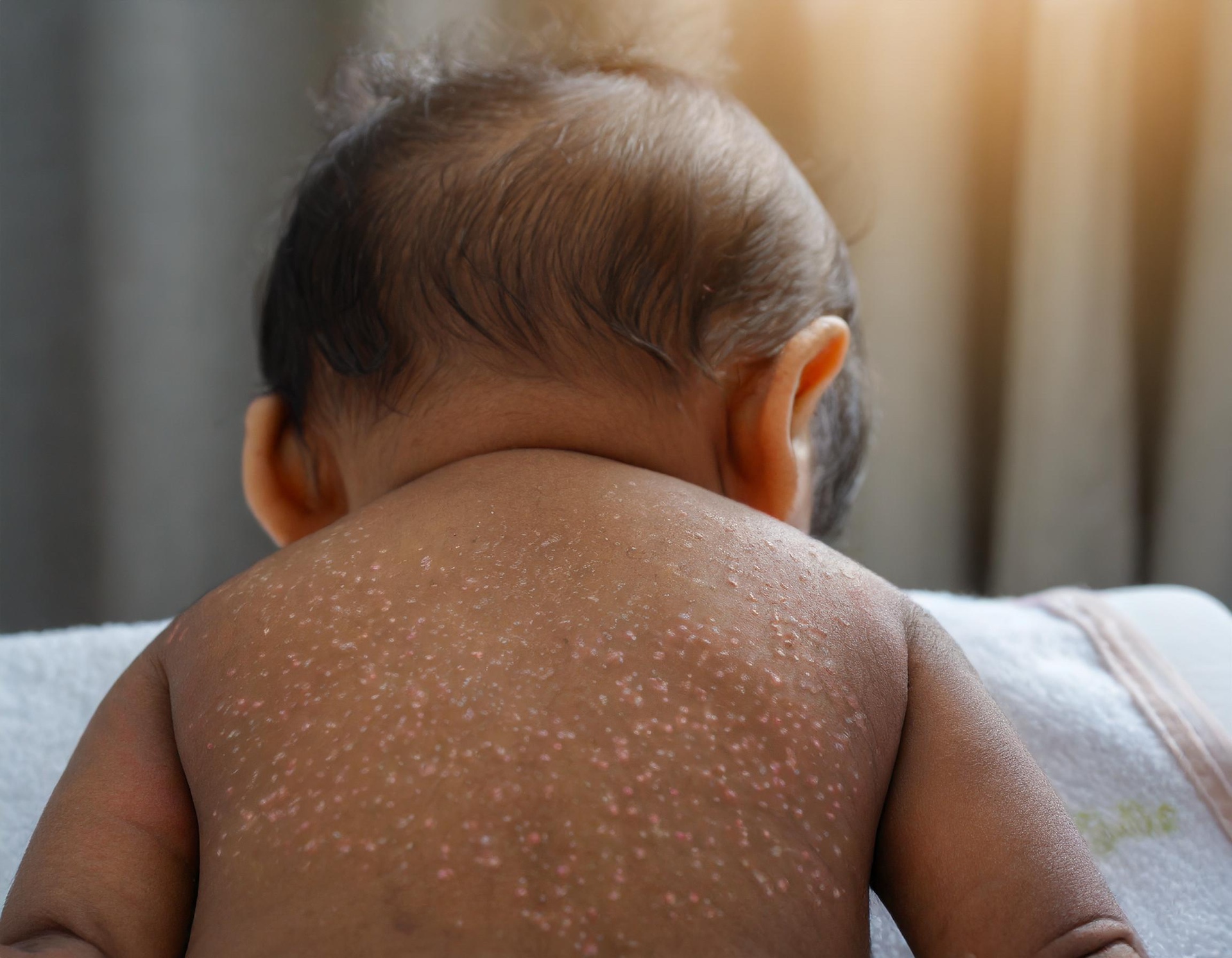 Baby with eczema on its back for article eczema in children
