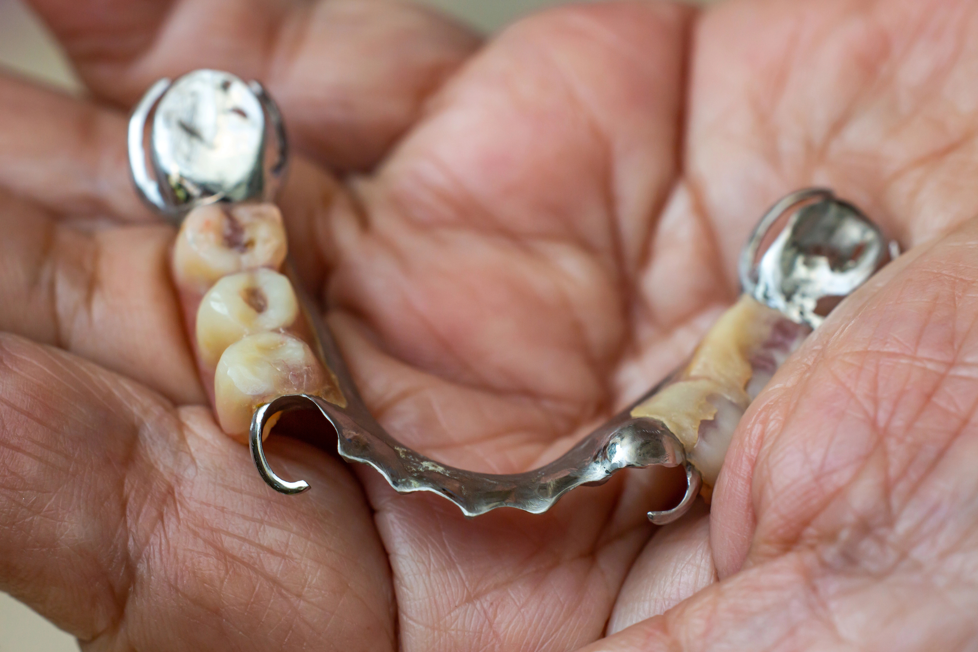 African american holding a dental bridge vs. Implant in their hand.